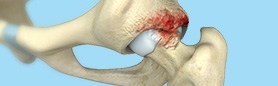 Femoroacetabular Impingement